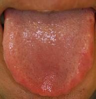 舌歯痕